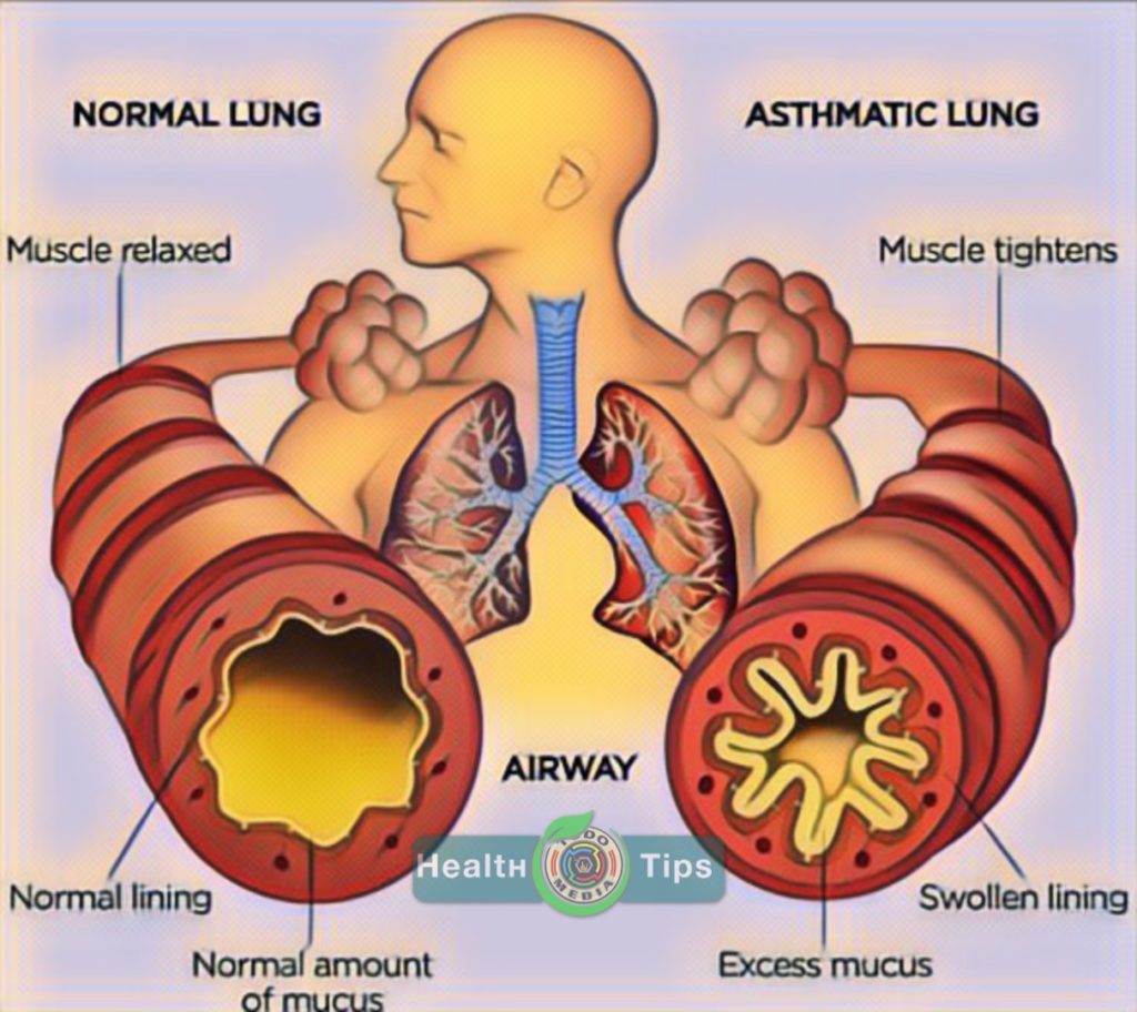 Causes of Asthma & its home remedies | Radyo Todo